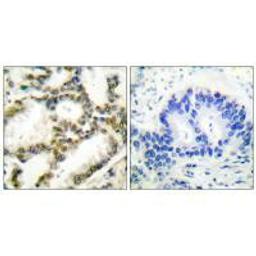 Immunohistochemical analysis of paraffin-embedded human lung carcinoma tissue using DJ-1 antibody.