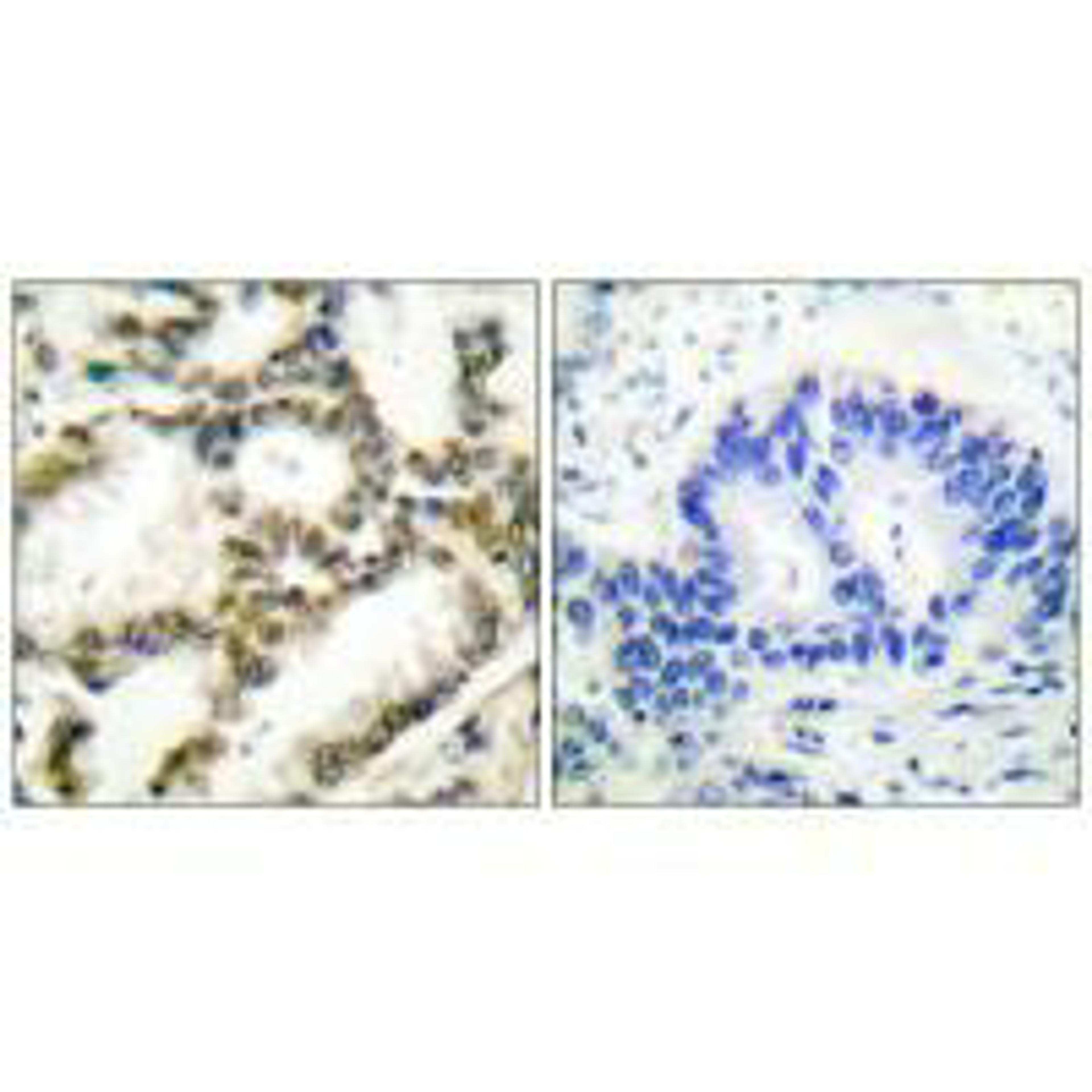 Immunohistochemical analysis of paraffin-embedded human lung carcinoma tissue using DJ-1 antibody.