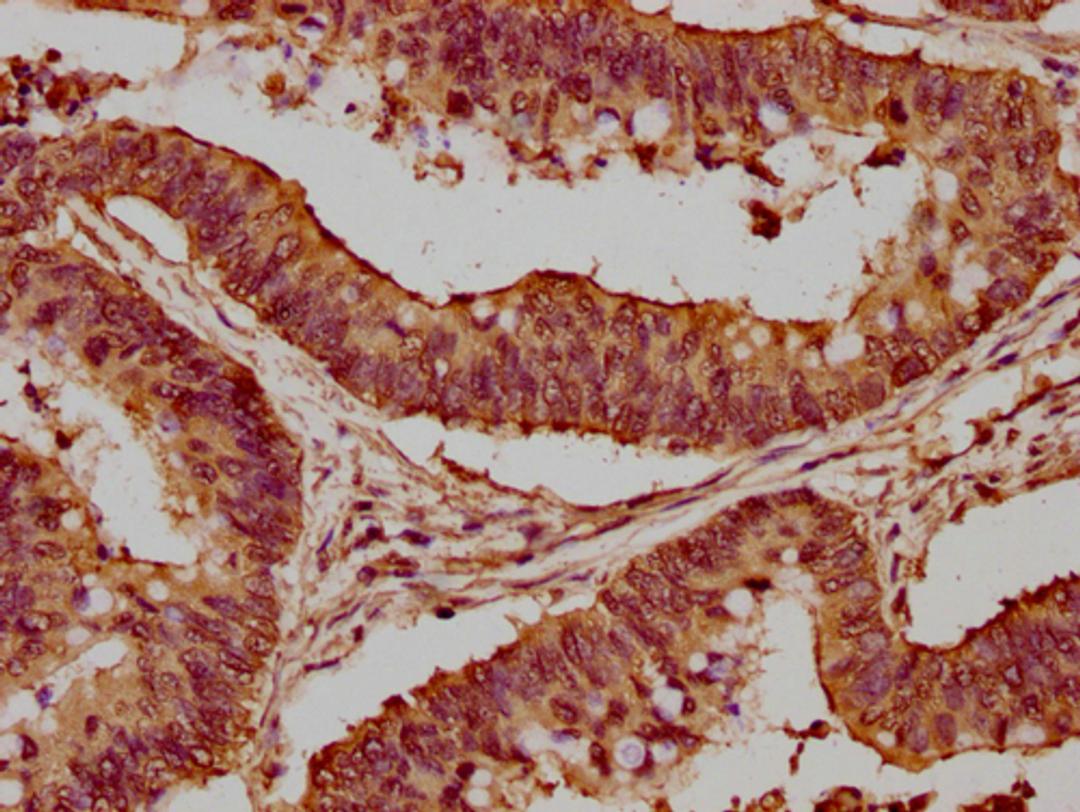 IHC image of CSB-PA010418PA56nme1HU diluted at 1:20 and staining in paraffin-embedded human colon cancer performed on a Leica BondTM system. After dewaxing and hydration, antigen retrieval was mediated by high pressure in a citrate buffer (pH 6.0). Section was blocked with 10% normal goat serum 30min at RT. Then primary antibody (1% BSA) was incubated at 4°C overnight. The primary is detected by a biotinylated secondary antibody and visualized using an HRP conjugated SP system.