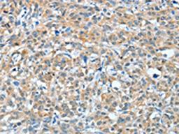 The image on the left is immunohistochemistry of paraffin-embedded Human esophagus cancer tissue using CSB-PA056537(BAG3 Antibody) at dilution 1/20, on the right is treated with fusion protein. (Original magnification: ×200)