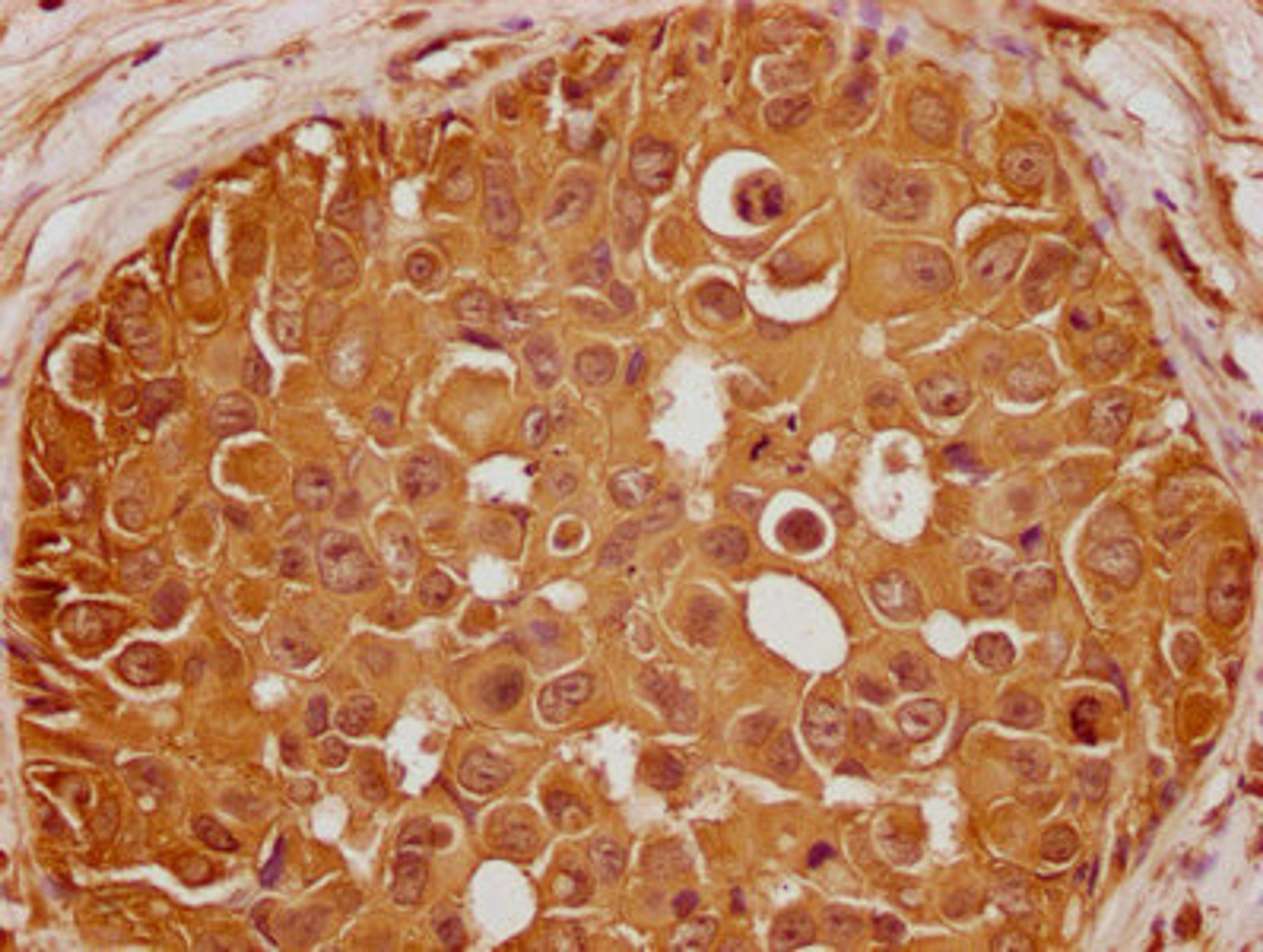IHC image of CSB-PA009500OA01HU diluted at 1:100 and staining in paraffin-embedded human breast cancer performed on a Leica BondTM system. After dewaxing and hydration, antigen retrieval was mediated by high pressure in a citrate buffer (pH 6.0). Section was blocked with 10% normal goat serum 30min at RT. Then primary antibody (1% BSA) was incubated at 4°C overnight. The primary is detected by a biotinylated secondary antibody and visualized using an HRP conjugated SP system.