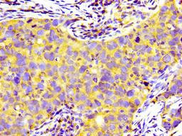 Immunohistochemistry of paraffin-embedded human pancreatic cancer using CSB-PA018739LA01HU at dilution of 1:100