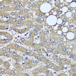 Immunohistochemical staining of human liver injury tissue using HYAL1 antibody (dilution of 1:100)