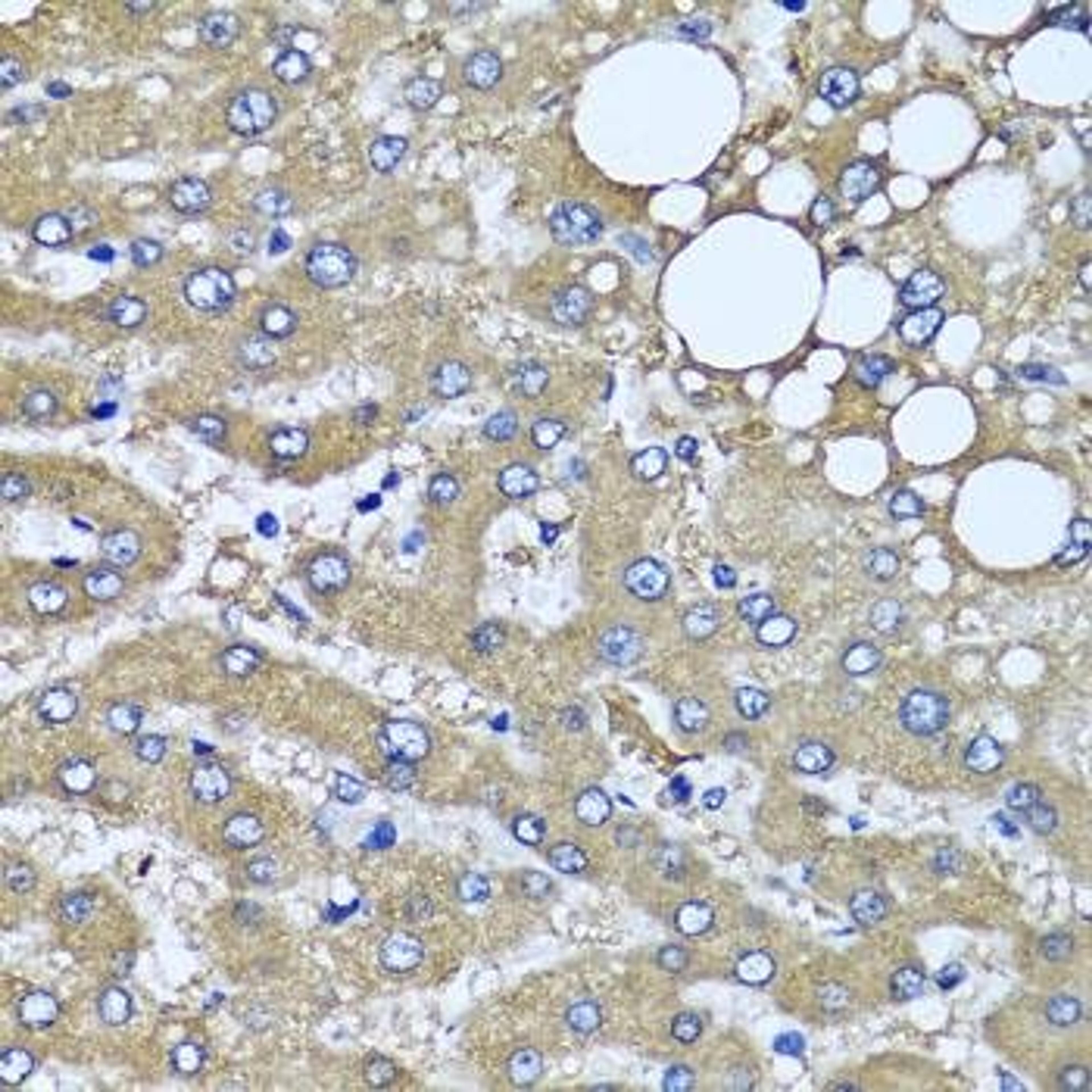 Immunohistochemical staining of human liver injury tissue using HYAL1 antibody (dilution of 1:100)