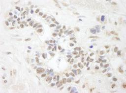 Immunohistochemistry-Paraffin: ANKS3 Antibody [NB100-61625] - Human breast carcinoma. Antibody used  at a dilution of 1:250.