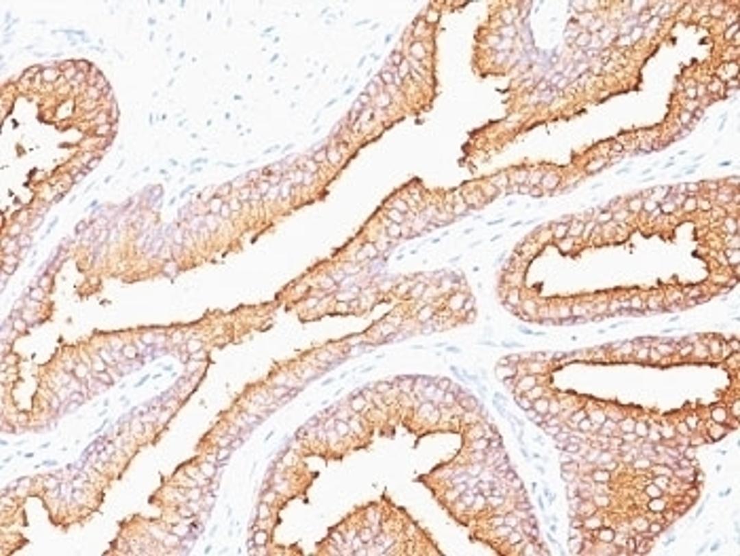 Formalin-fixed, paraffin-embedded human prostate carcinoma stained with PSA antibody (SPM352).