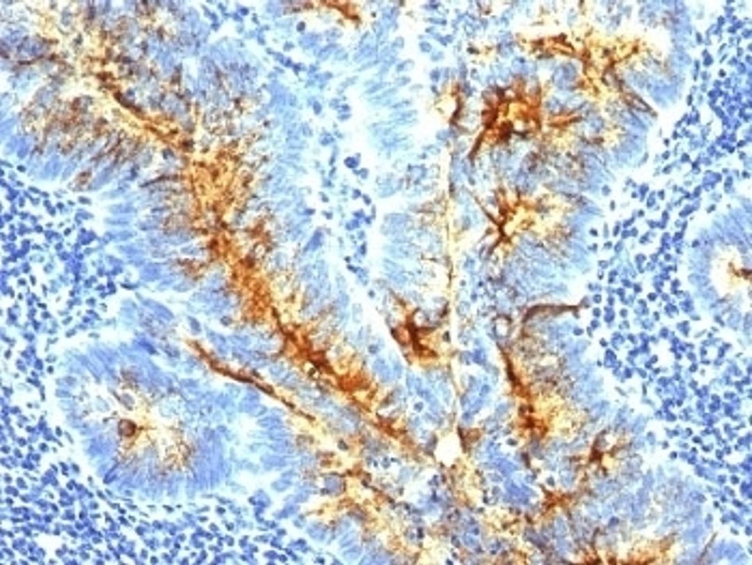 Formalin-fixed, paraffin-embedded human colon carcinoma stained with TAG-72 antibody (SPM536).