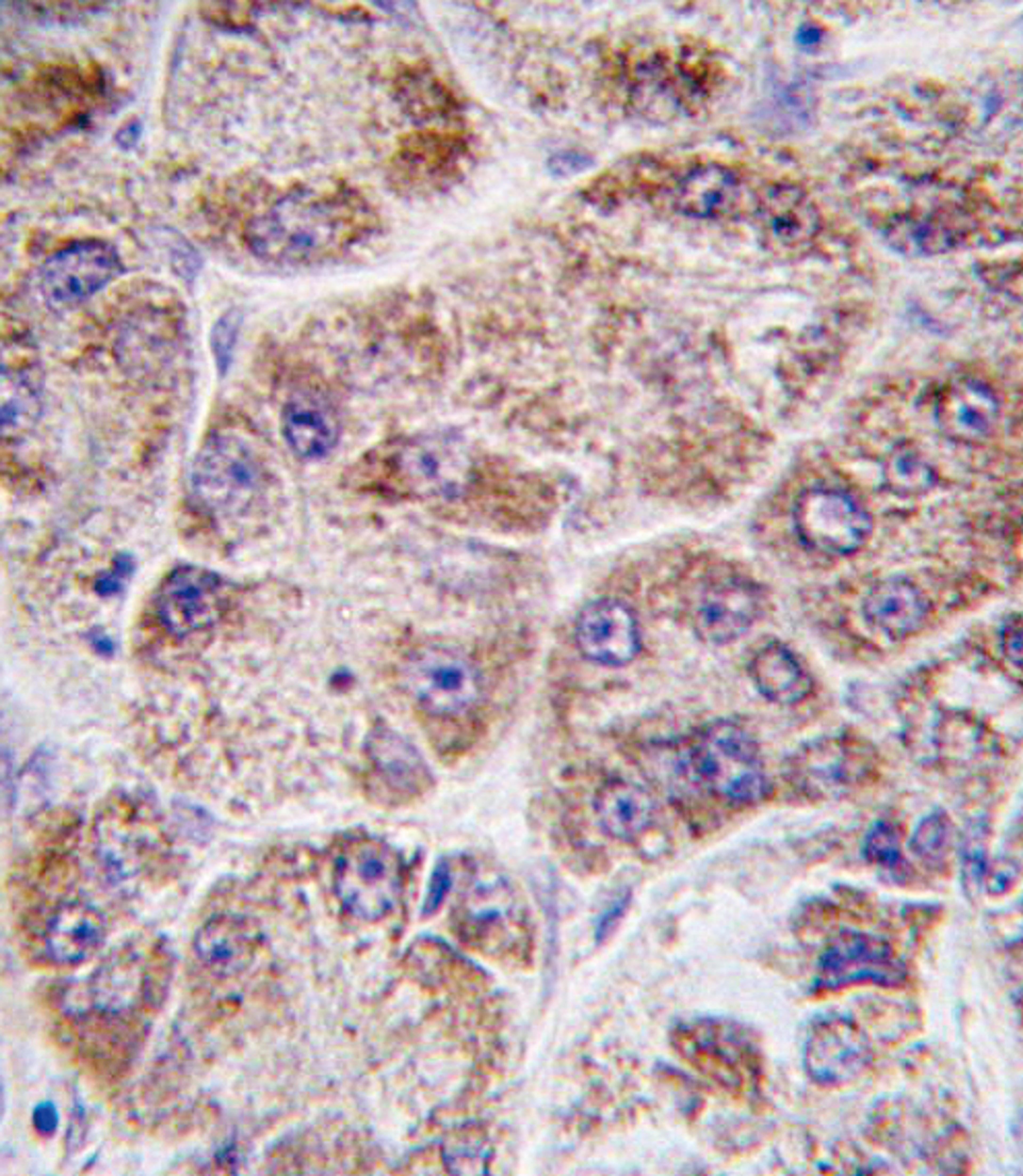 Formalin-fixed and paraffin-embedded human hepatocarcinoma tissue reacted with FDPS antibody (Center ), which was peroxidase-conjugated to the secondary antibody, followed by DAB staining.