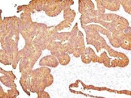 IHC testing of FFPE human colon carcinoma with EpCAM antibody.