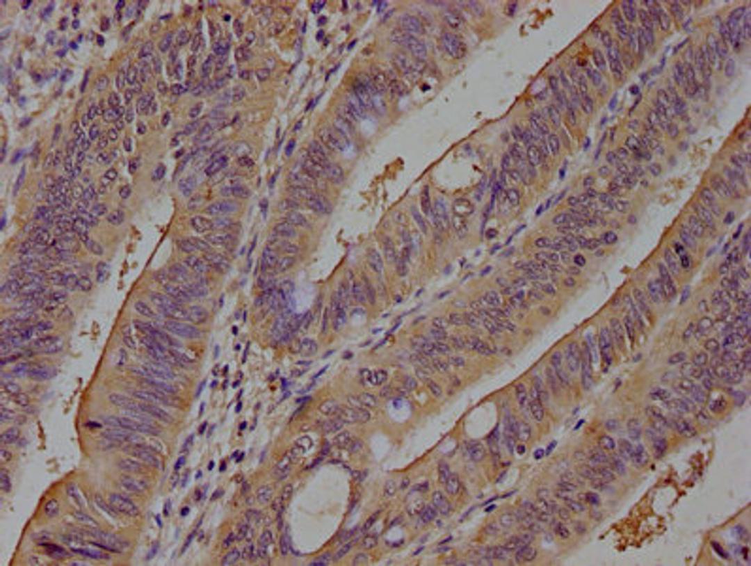 IHC image of CSB-PA07039A0Rb diluted at 1:100 and staining in paraffin-embedded human colon cancer performed on a Leica BondTM system. After dewaxing and hydration, antigen retrieval was mediated by high pressure in a citrate buffer (pH 6.0). Section was blocked with 10% normal goat serum 30min at RT. Then primary antibody (1% BSA) was incubated at 4°C overnight. The primary is detected by a biotinylated secondary antibody and visualized using an HRP conjugated SP system.