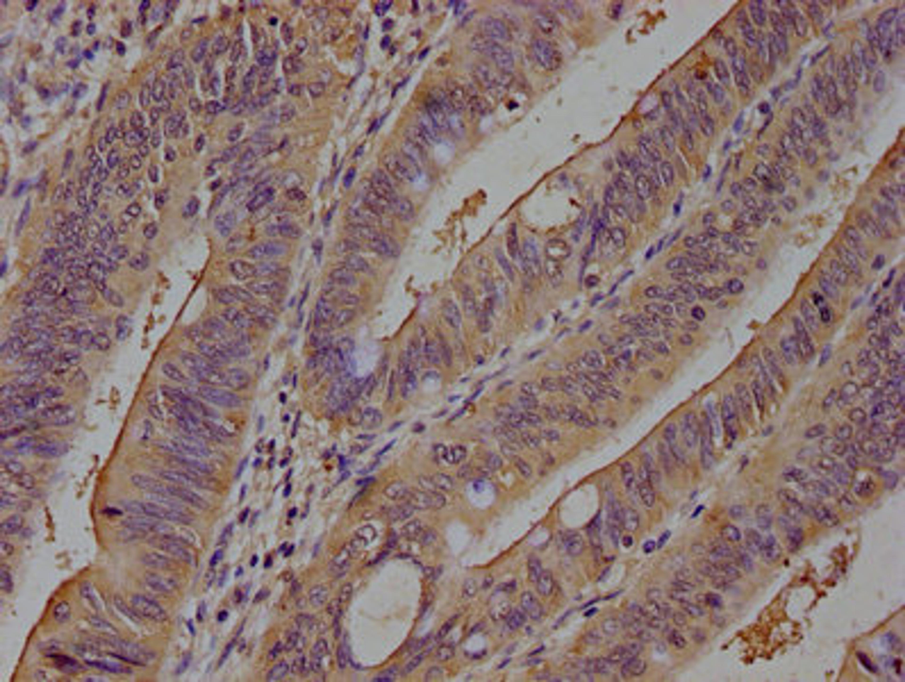 IHC image of CSB-PA07039A0Rb diluted at 1:100 and staining in paraffin-embedded human colon cancer performed on a Leica BondTM system. After dewaxing and hydration, antigen retrieval was mediated by high pressure in a citrate buffer (pH 6.0). Section was blocked with 10% normal goat serum 30min at RT. Then primary antibody (1% BSA) was incubated at 4°C overnight. The primary is detected by a biotinylated secondary antibody and visualized using an HRP conjugated SP system.