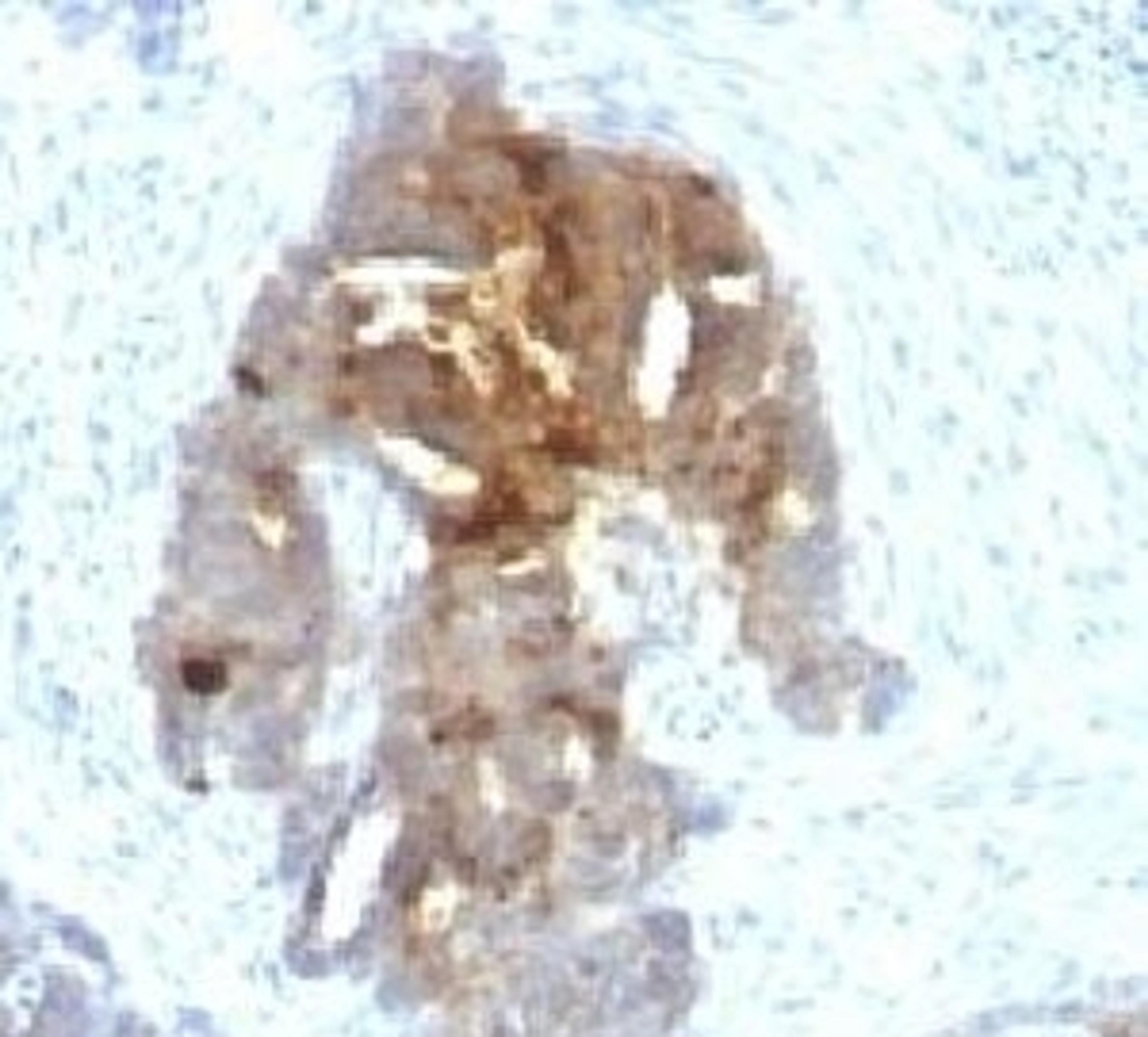 IHC testing of human ovarian carcinoma with TAG-72 antibody.