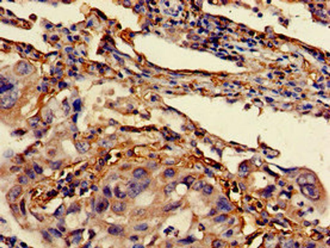 Immunohistochemistry of paraffin-embedded human lung cancer using CSB-PA12959A0Rb at dilution of 1:100