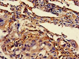 Immunohistochemistry of paraffin-embedded human lung cancer using CSB-PA12959A0Rb at dilution of 1:100