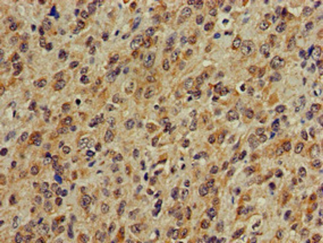 Immunohistochemistry of paraffin-embedded human glioma using CSB-PA865102LA01HU at dilution of 1:100
