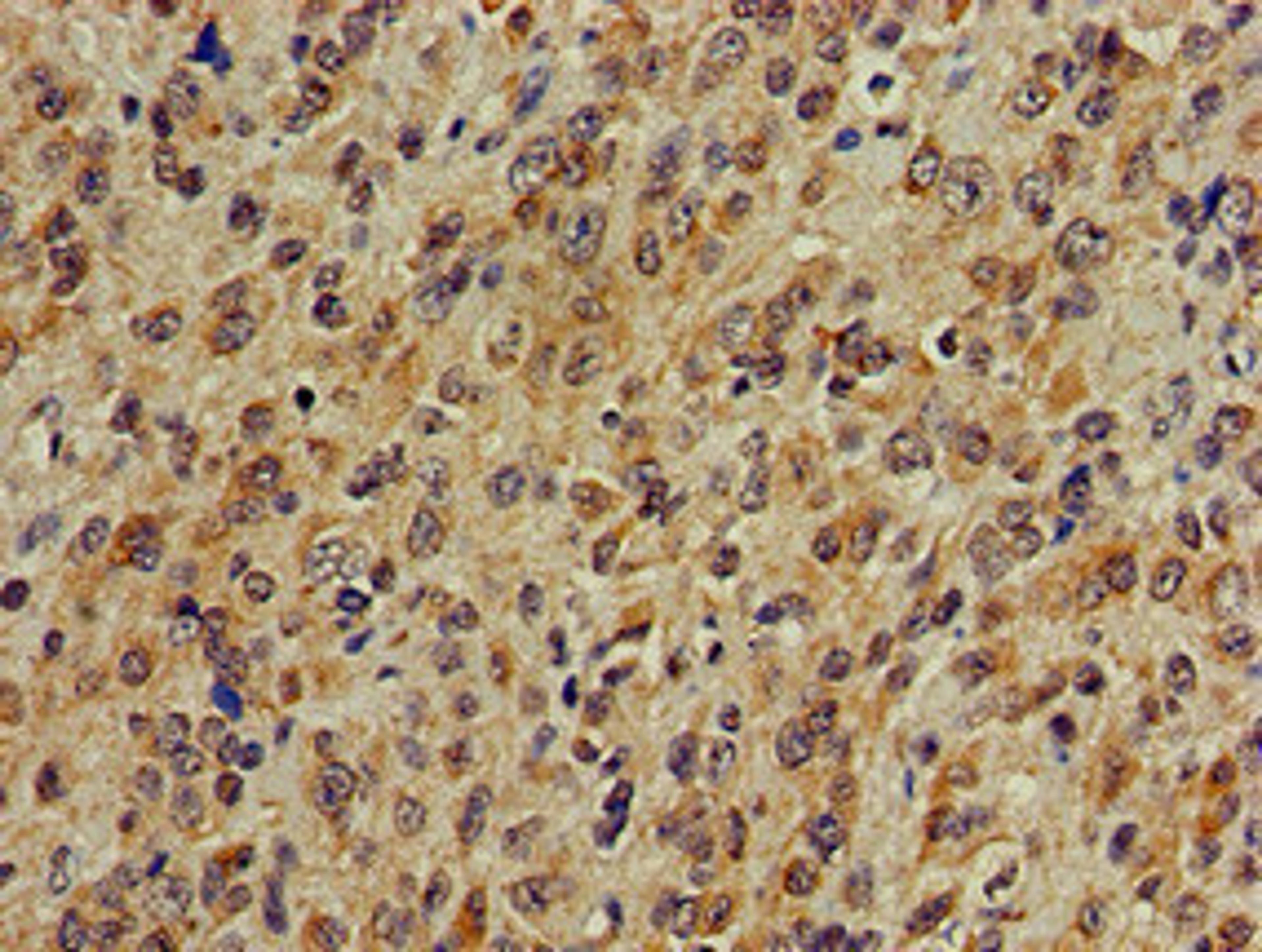 Immunohistochemistry of paraffin-embedded human glioma using CSB-PA865102LA01HU at dilution of 1:100