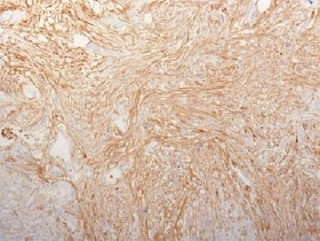 IHC testing of FFPE pancreatic adenocarcinoma and Fibronectin antibody