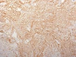 IHC testing of FFPE pancreatic adenocarcinoma and Fibronectin antibody