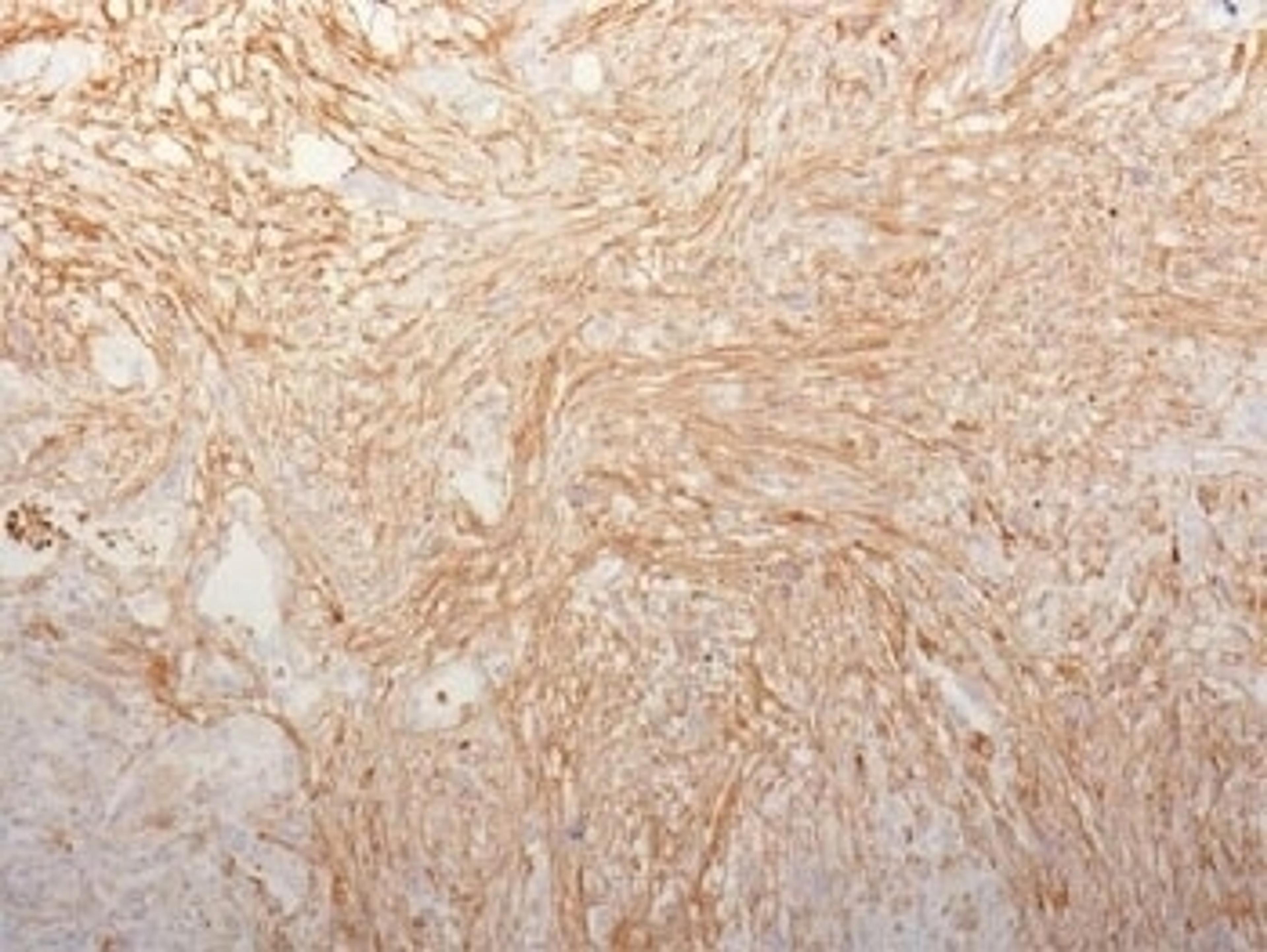 IHC testing of FFPE pancreatic adenocarcinoma and Fibronectin antibody