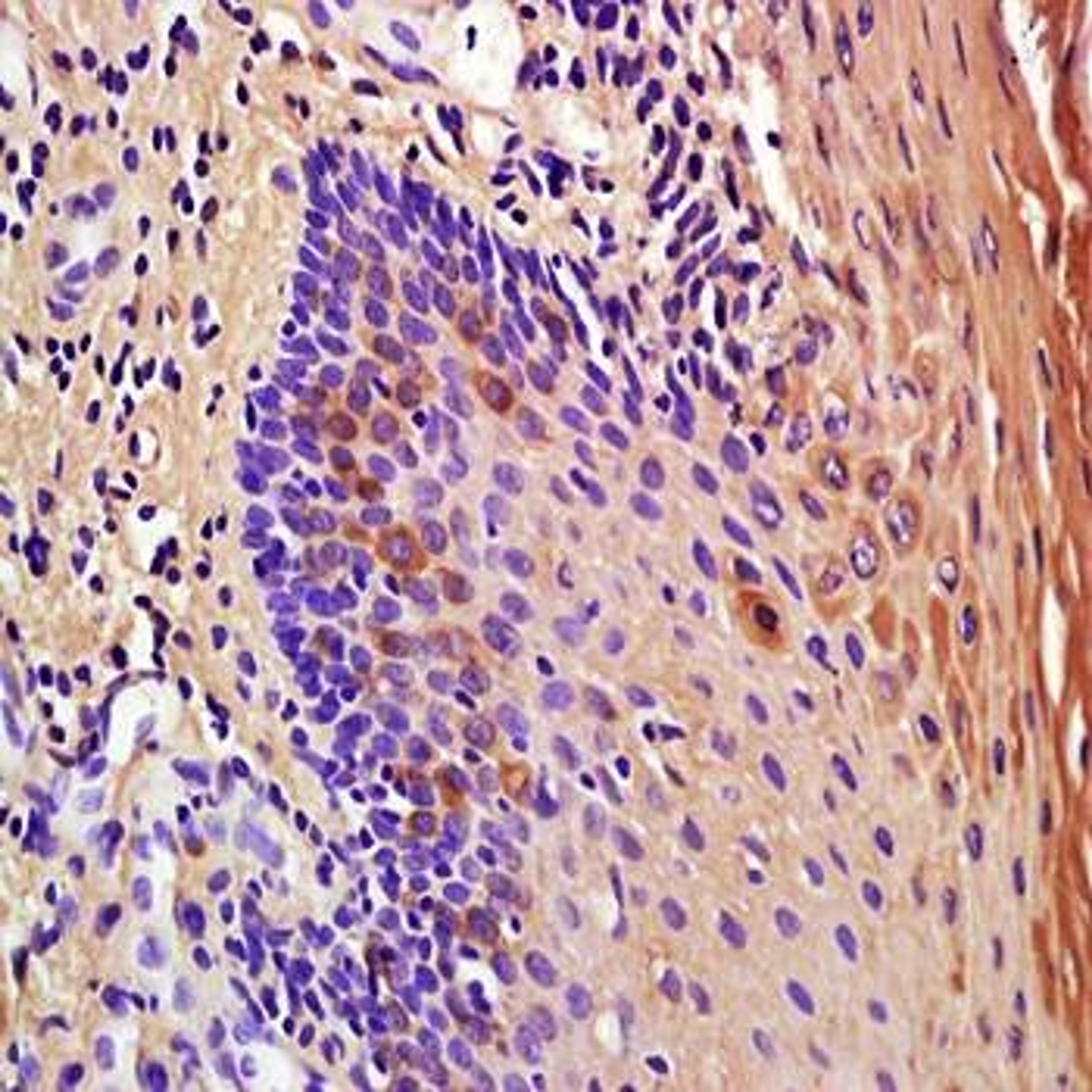 Immunohistochemical analysis of formalin-fixed and paraffin embedded human oral squamous cell carcinoma tissue (Dilution at:1:200) using IL1RA antibody