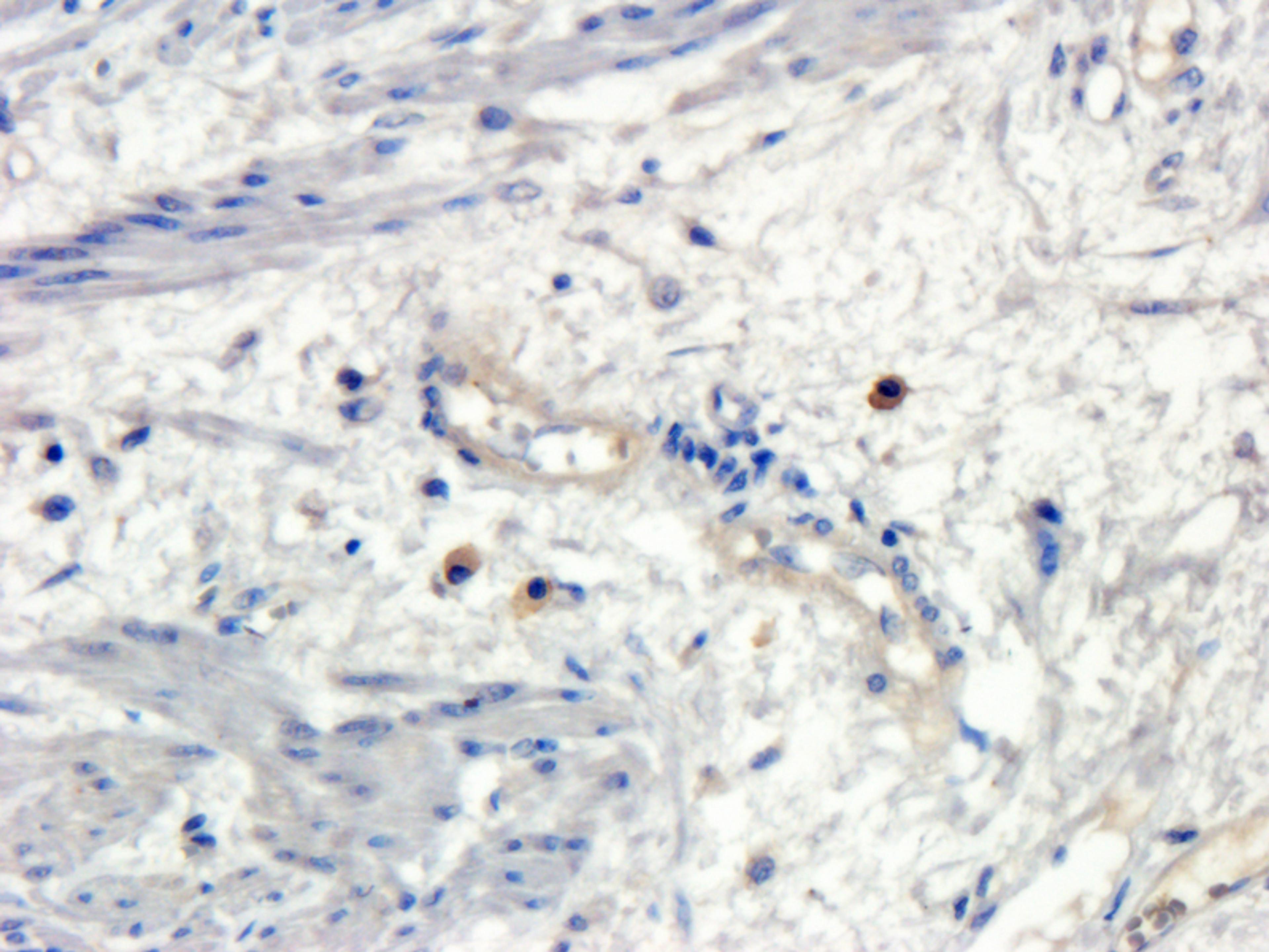 IHC-P image of human endometrial cancer tissue using Osteocalcin antibody (2.5 ug/ml)