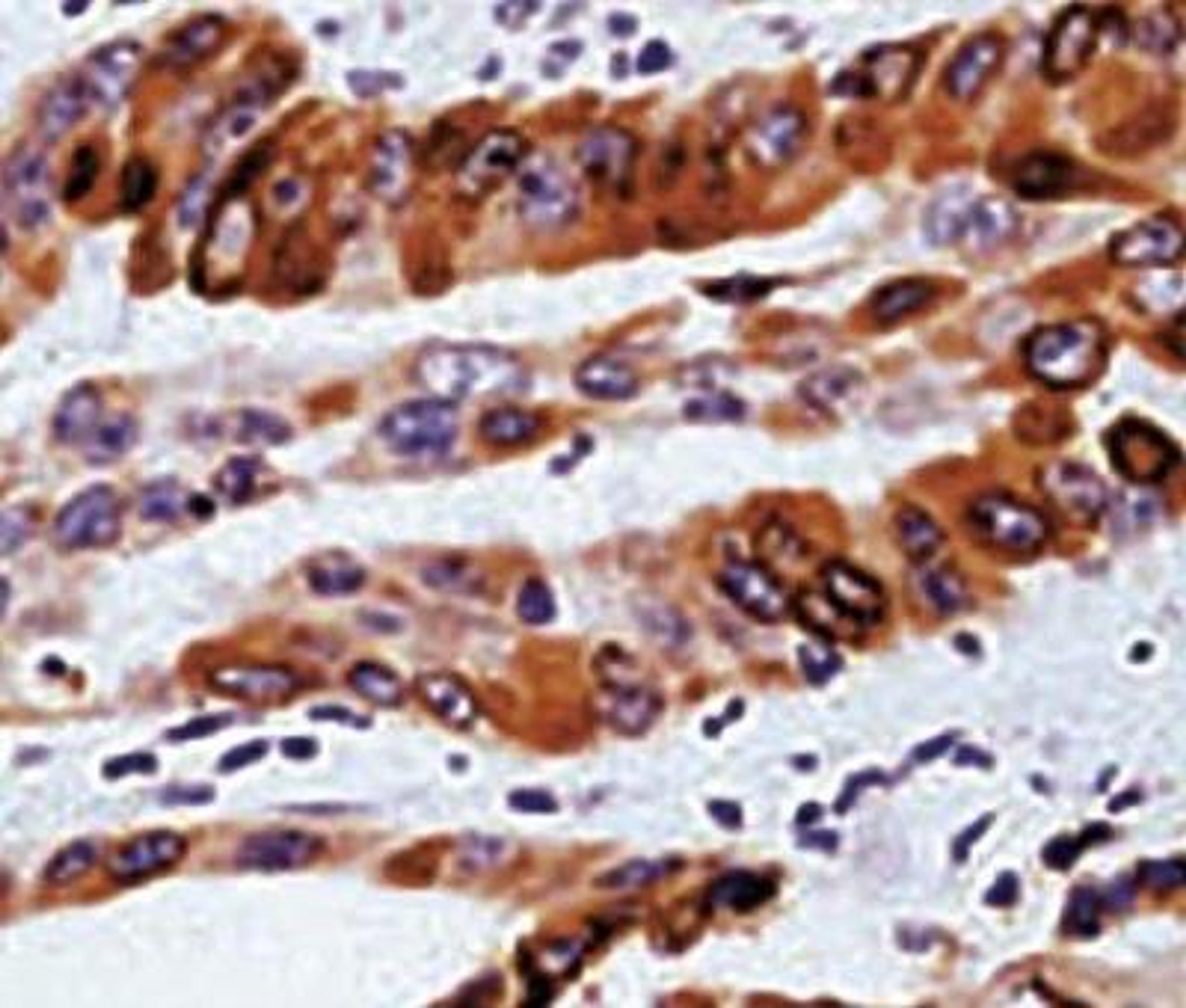 Immunohistochemistry-Paraffin: COX-2 Antibody [NB100-689] - Formalin fixed paraffin embedded human colon carcinoma stained with COX2 antibody.