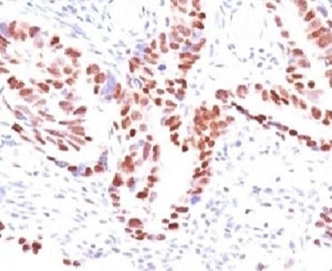 Formalin-fixed, paraffin-embedded human colon carcinoma stained with p57 antibody (KIP2/880).