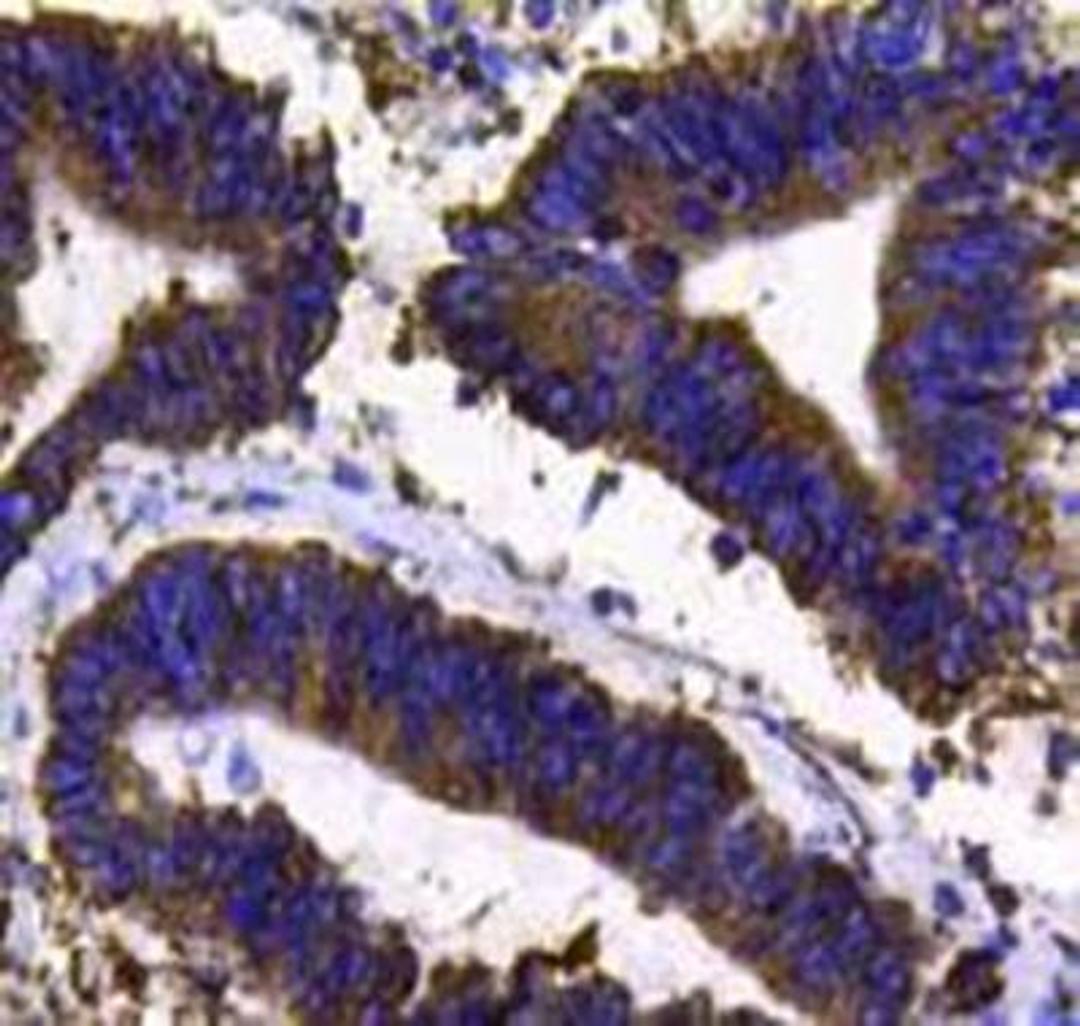 Immunohistochemical staining of human colon carcinoma tissue using PDI antibody