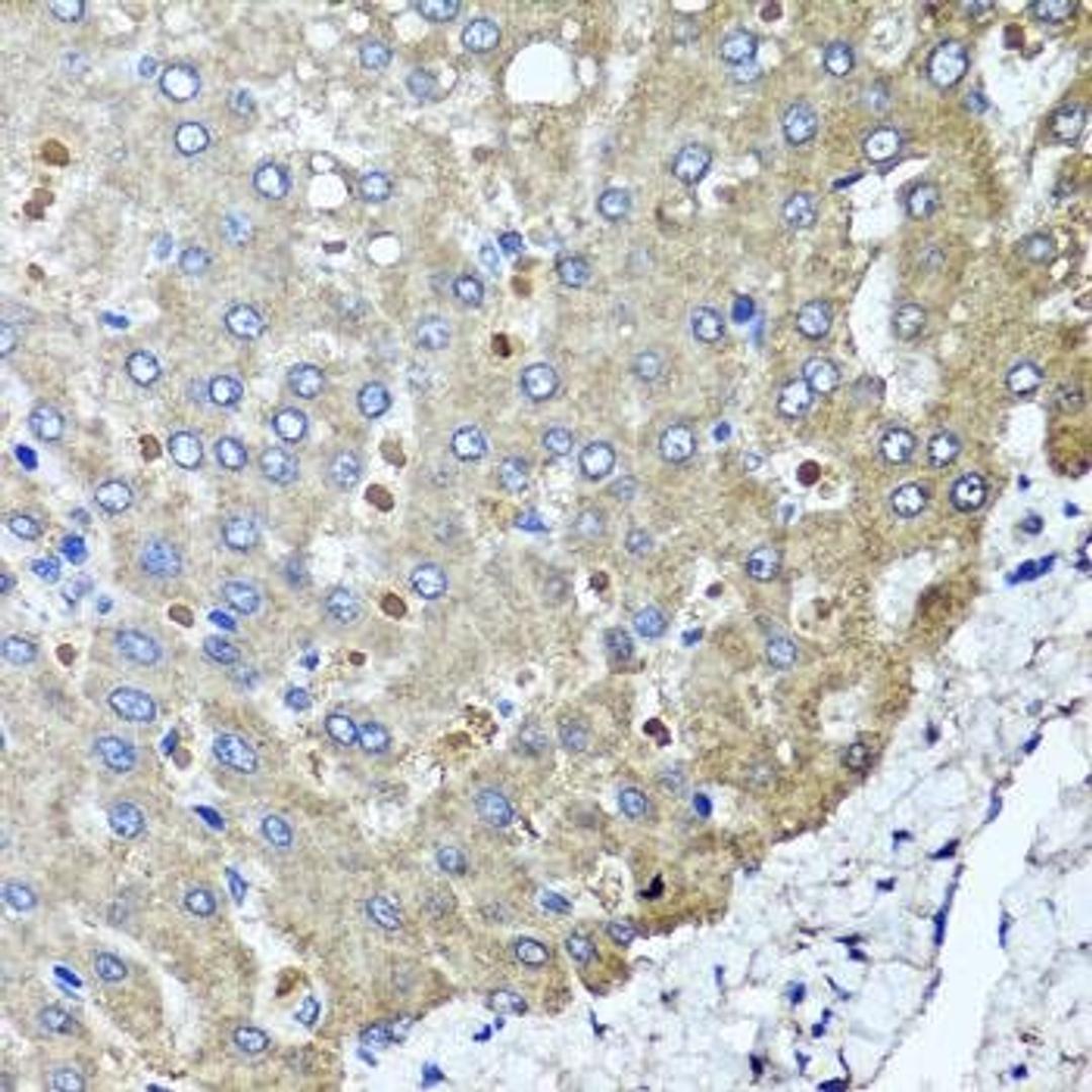 Immunohistochemical staining of human colon carcinoma tissue using PPOX antibody (dilution of 1:100)