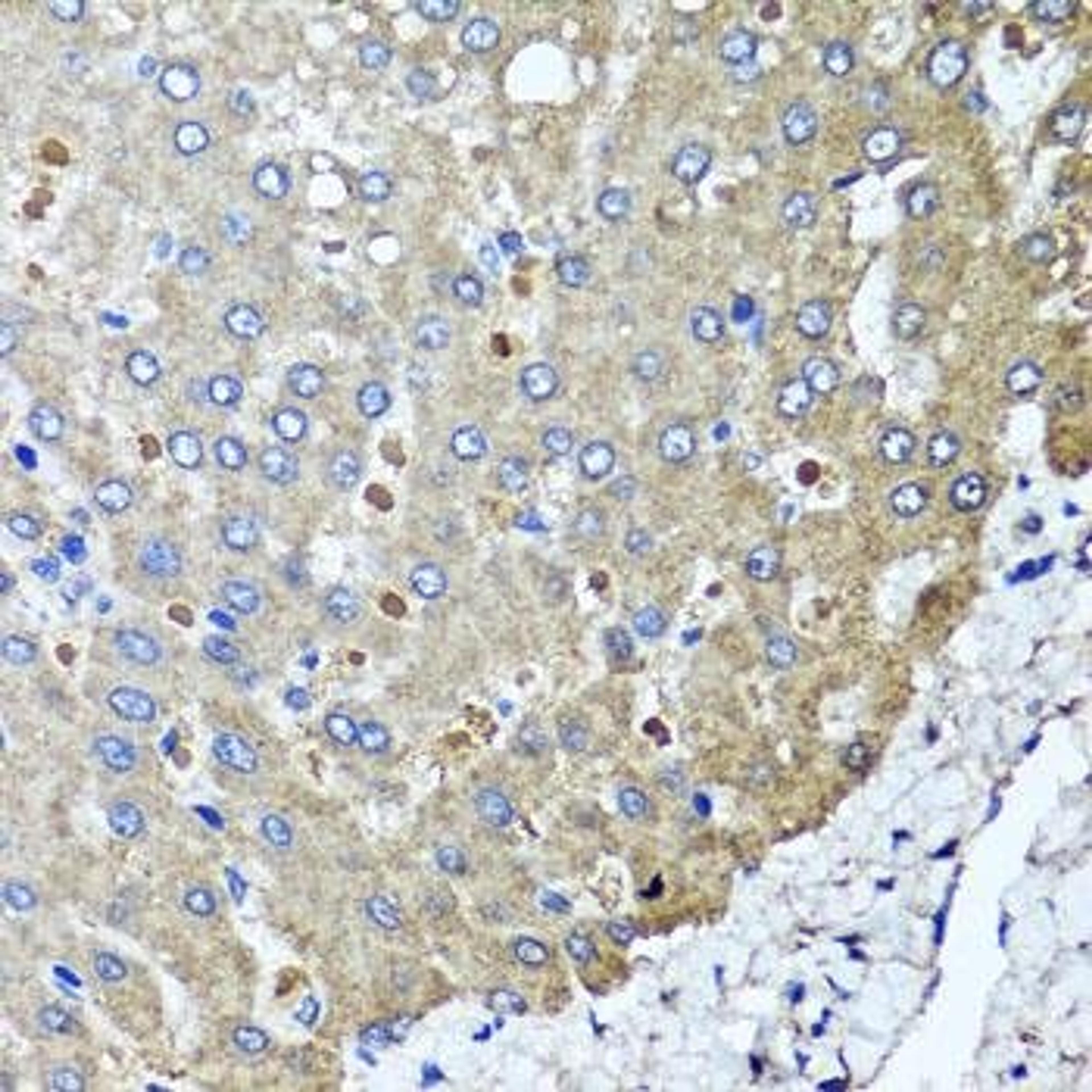 Immunohistochemical staining of human colon carcinoma tissue using PPOX antibody (dilution of 1:100)