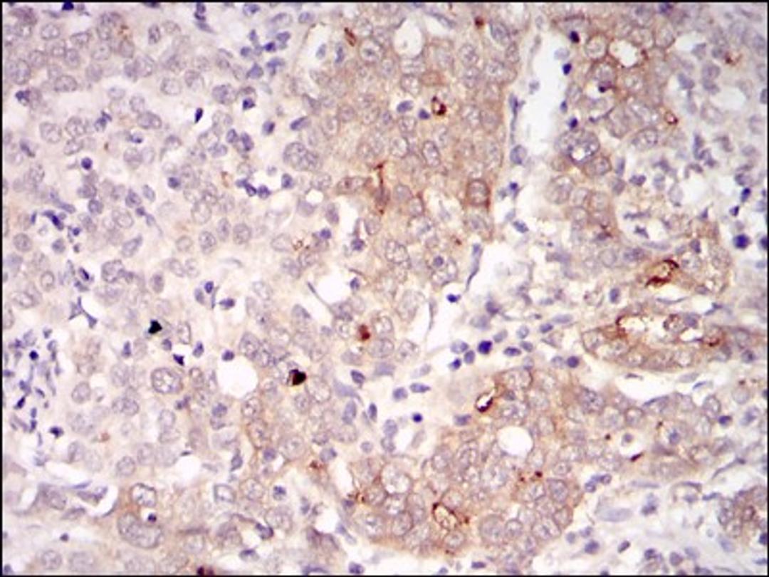 Immunohistochemistry: BLNK Antibody (5G9) [NBP2-37585] - Immunohistochemical analysis of paraffin-embedded human cervical cancer tissues using BLNK mouse mAb with DAB staining.