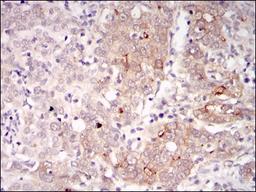 Immunohistochemistry: BLNK Antibody (5G9) [NBP2-37585] - Immunohistochemical analysis of paraffin-embedded human cervical cancer tissues using BLNK mouse mAb with DAB staining.