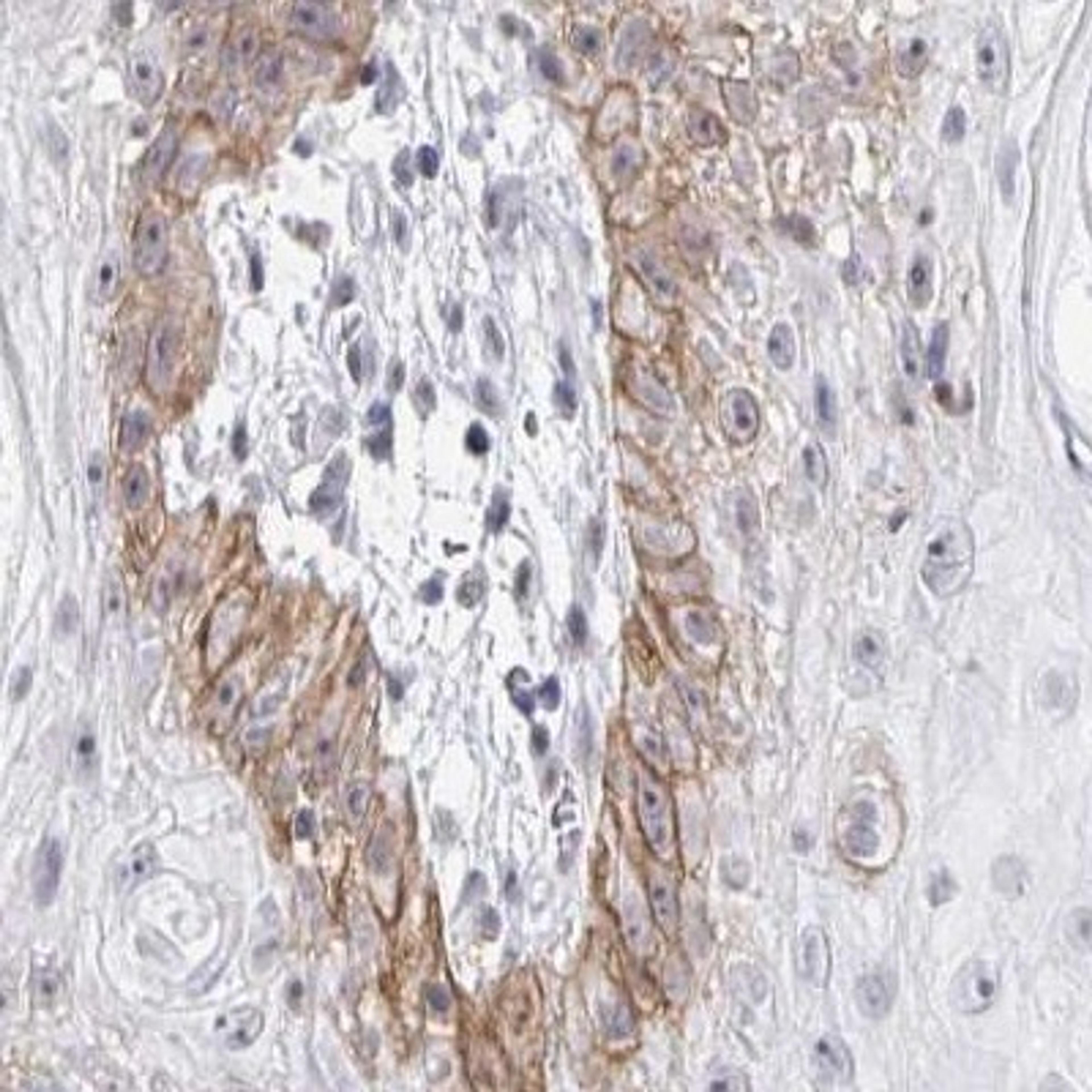 Immunohistochemistry: COL28A1 Antibody [NBP2-32547] - skin cancer