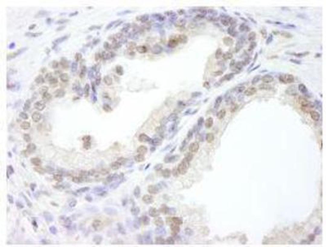 Immunohistochemistry-Paraffin: USP47 Antibody [NB100-57487] - FFPE section of human prostate adenocarcinoma. Affinity purified rabbit anti-USP47 used at a dilution of 1:100.