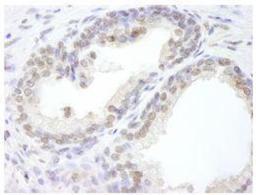 Immunohistochemistry-Paraffin: USP47 Antibody [NB100-57487] - FFPE section of human prostate adenocarcinoma. Affinity purified rabbit anti-USP47 used at a dilution of 1:100.