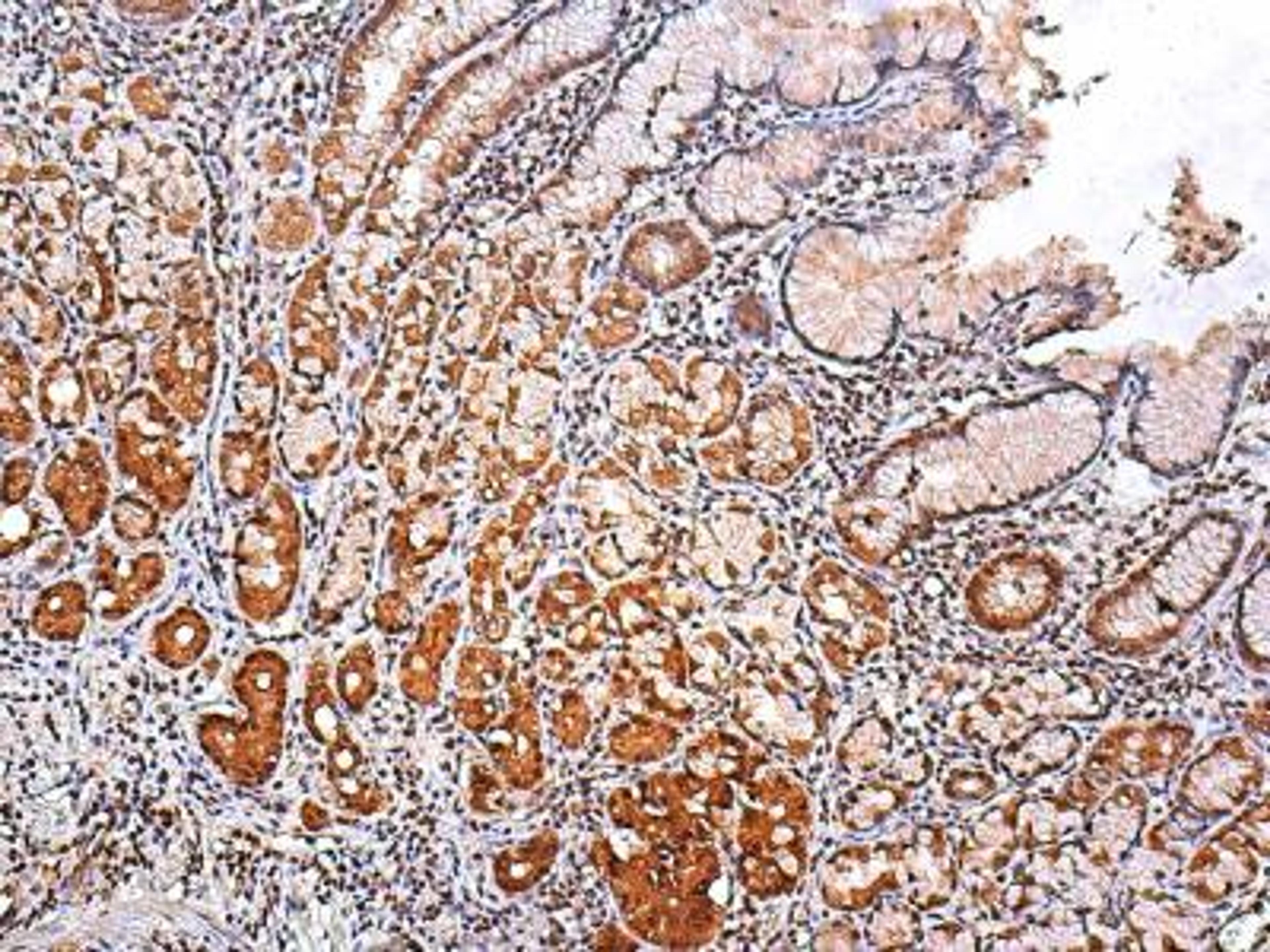 Immunohistochemistry: Slug Antibody [NBP2-27182] -  Immunohistochemistry analysis of gastric cancer using Slug antibody (NBP2-27182) at 1:25. Image objective 100x.