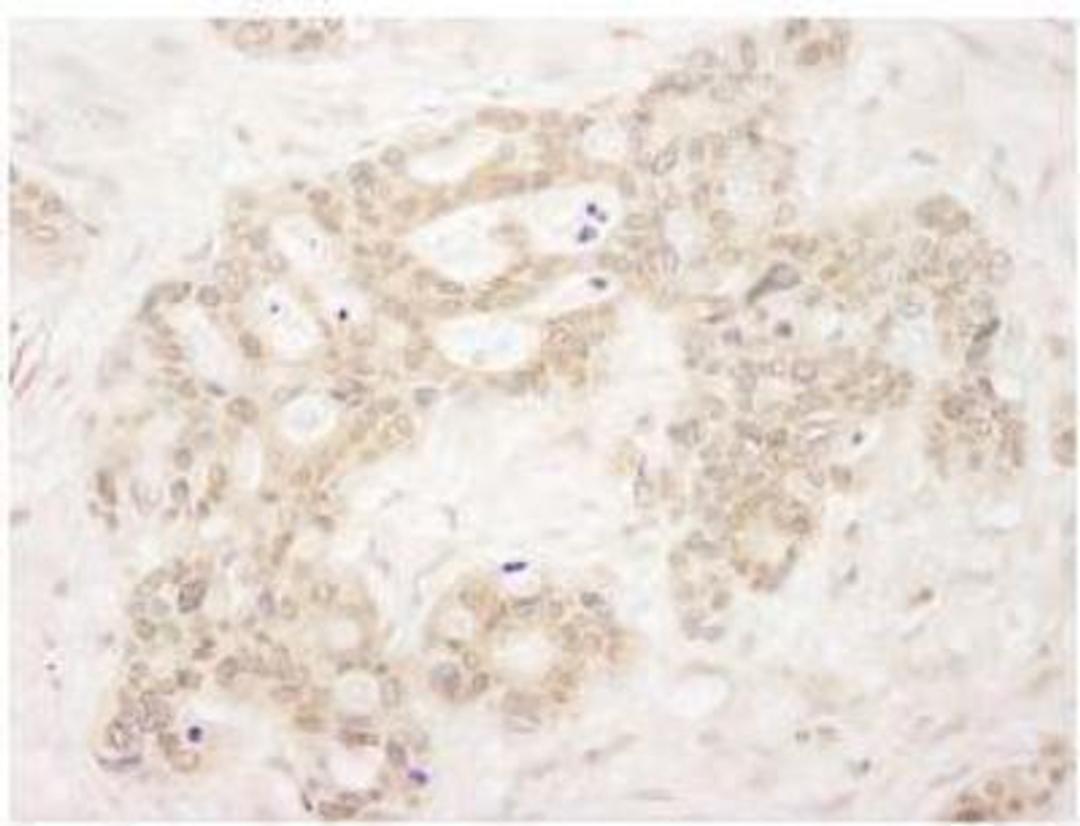 Immunohistochemistry-Paraffin: QSER1 Antibody [NBP1-19112] - FFPE section of human ovarian carcinoma.  Affinity purified rabbit anti-QSER used at a dilution of 1:250.