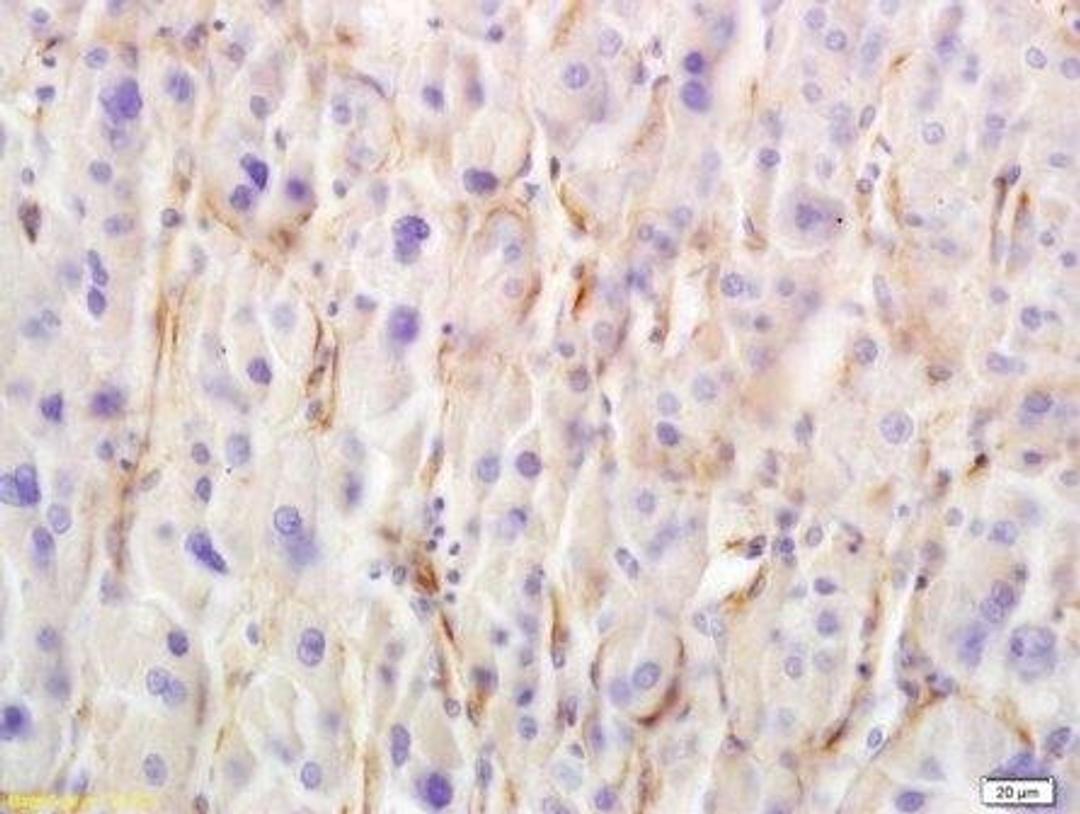 Immunohistochemical analysis of paraffin-embedded human liver cancer tissue using Layilin antibody