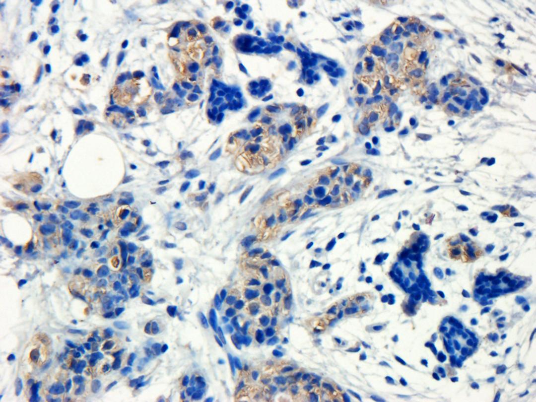 Immunohistochemical staining of paraffin embedded human breast cancer tissue using anti-GP1BA (primary antibody at 1:200)