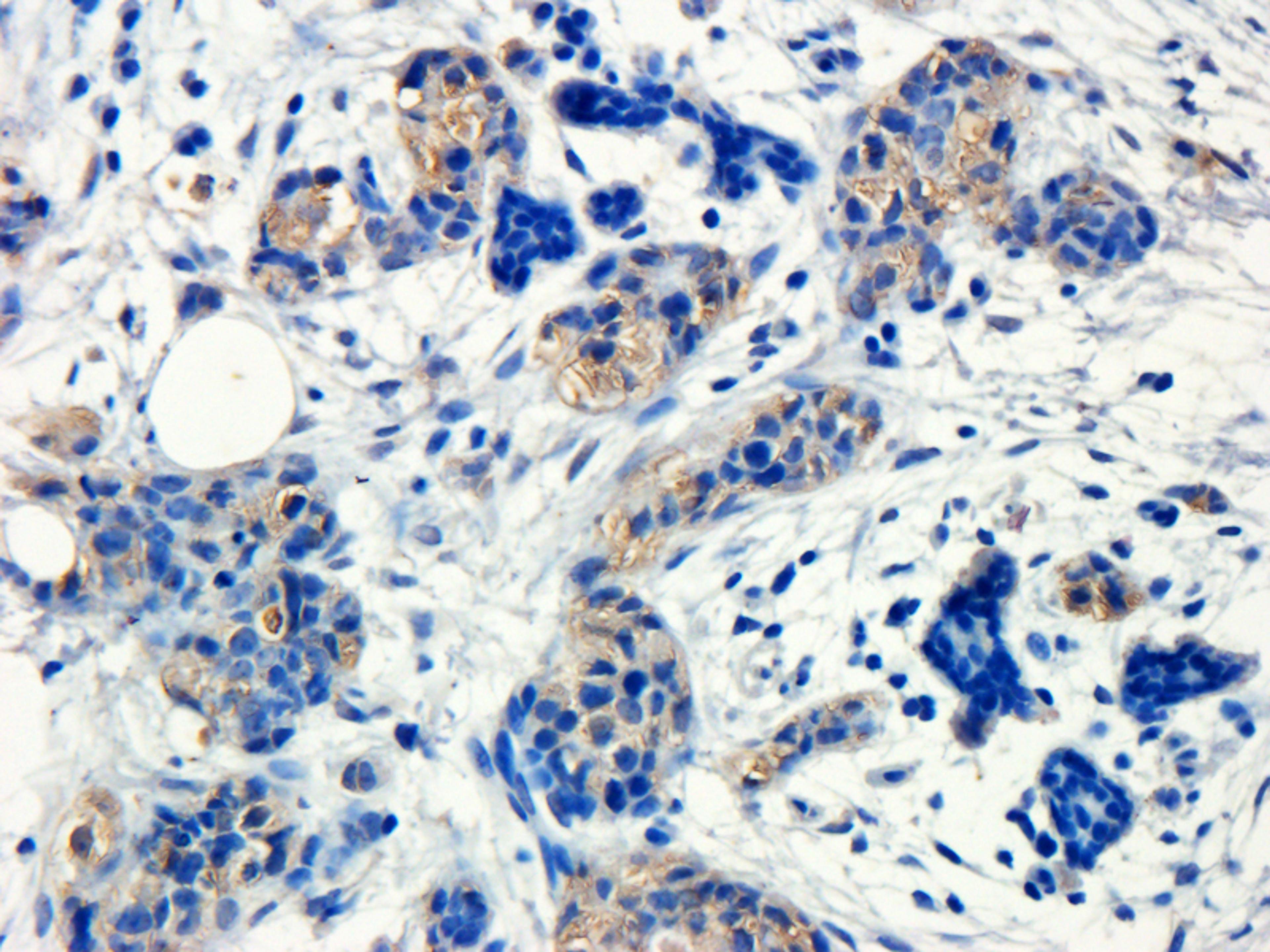 Immunohistochemical staining of paraffin embedded human breast cancer tissue using anti-GP1BA (primary antibody at 1:200)