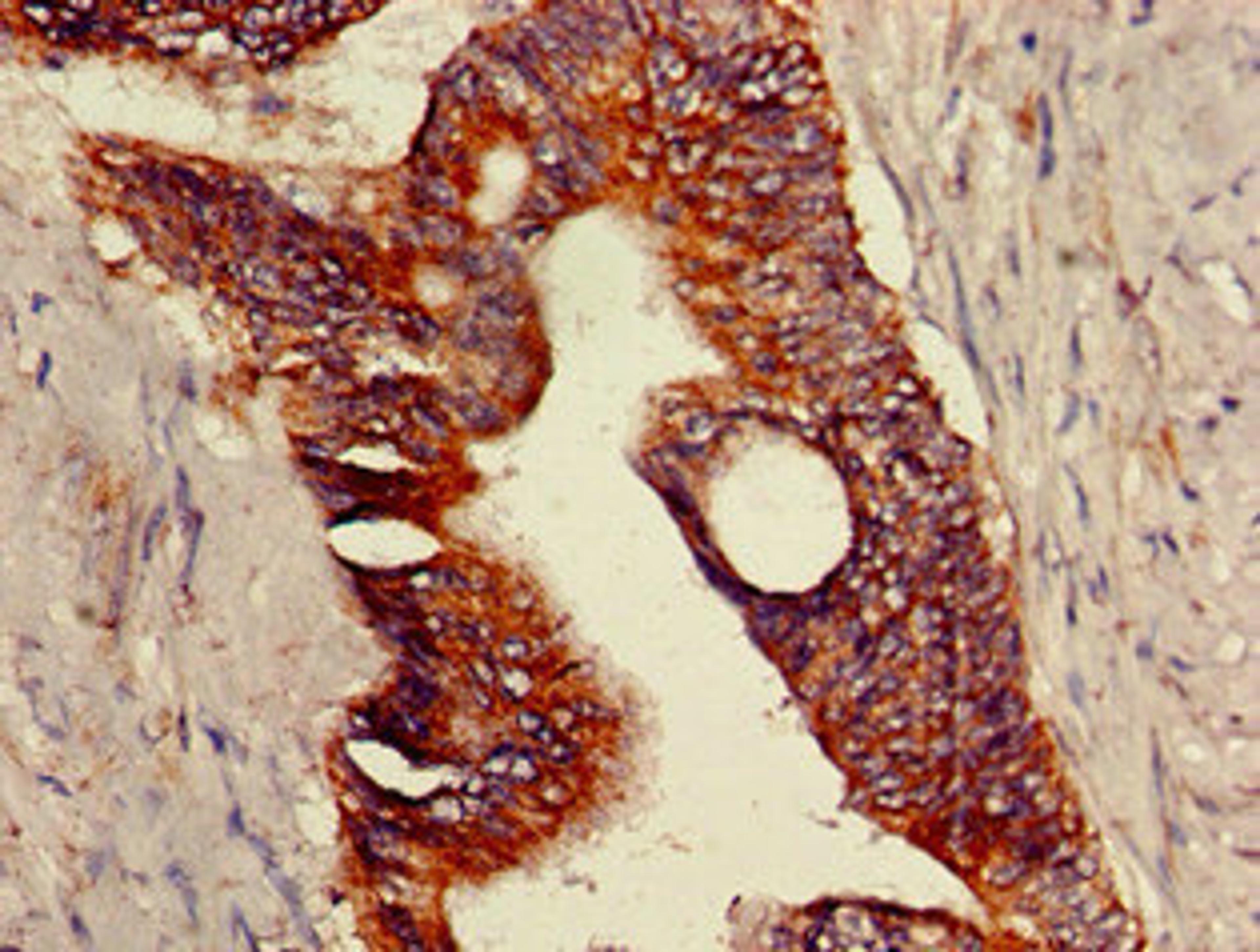Immunohistochemistry of paraffin-embedded human colon cancer using CSB-PA822774LA01HU at dilution of 1:100