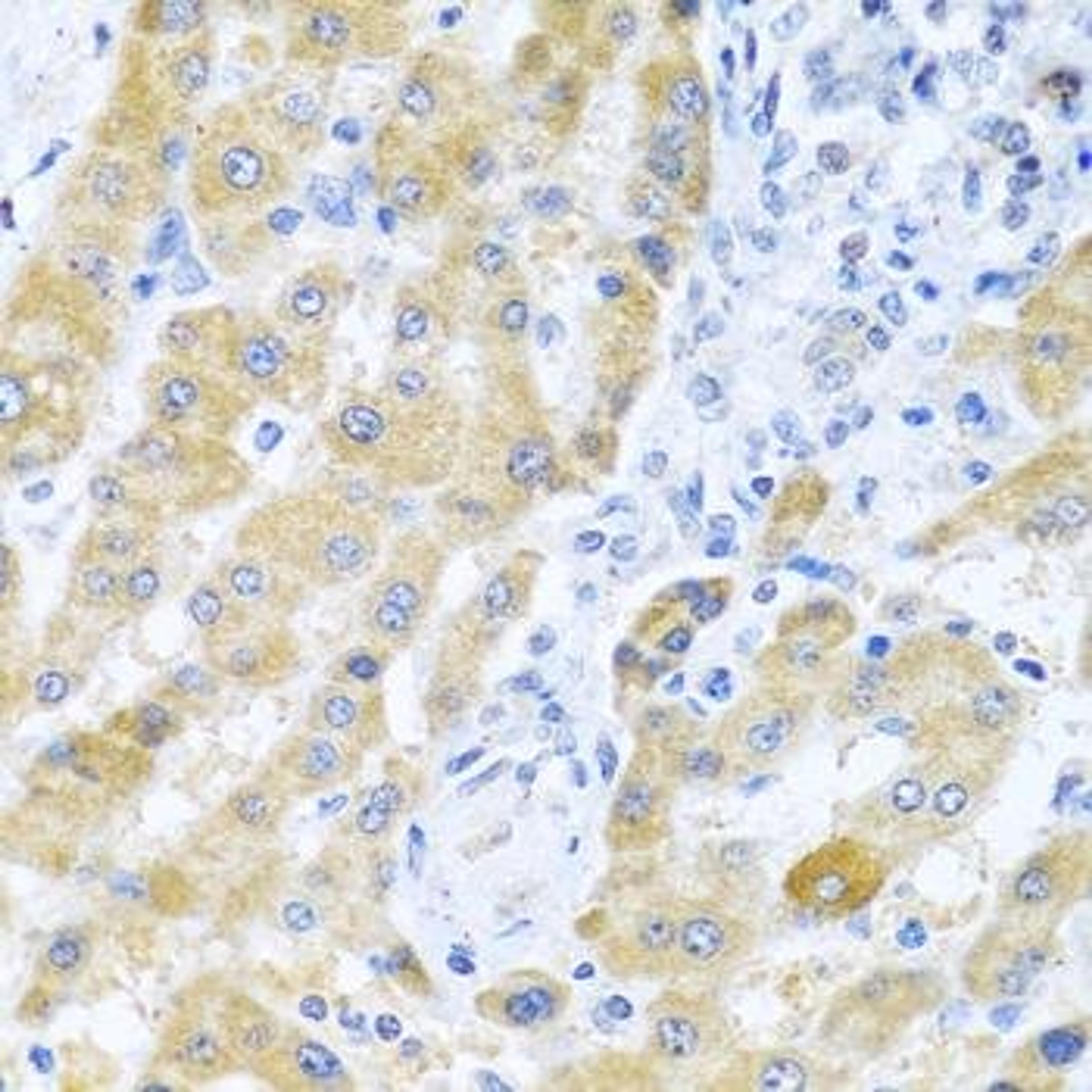 Immunohistochemical staining of human liver cancer tissue using Gm13125 antibody (dilution of 1:100)