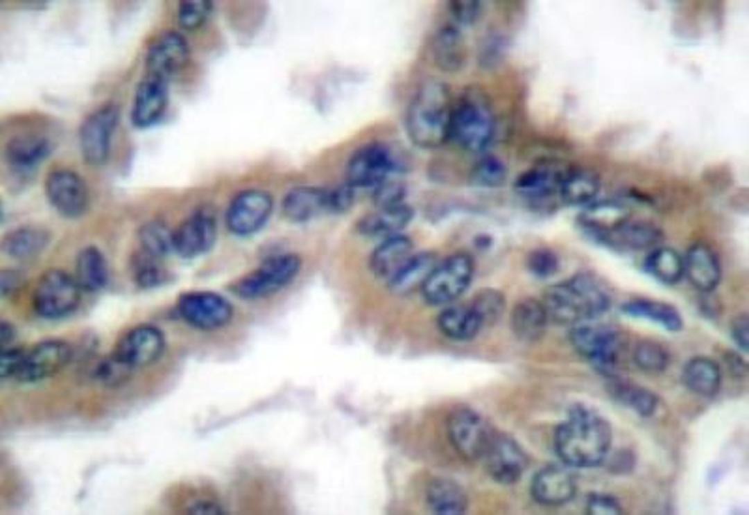 Immunohistochemistry: Hsp40/DNAJB1 Antibody [NB100-91818] -  - Immunohistochemistry  (IHC)  analyzes of  HSP40/HDJ-1 (P303) antibody in paraffin-embedded  lung carcinoma tissue