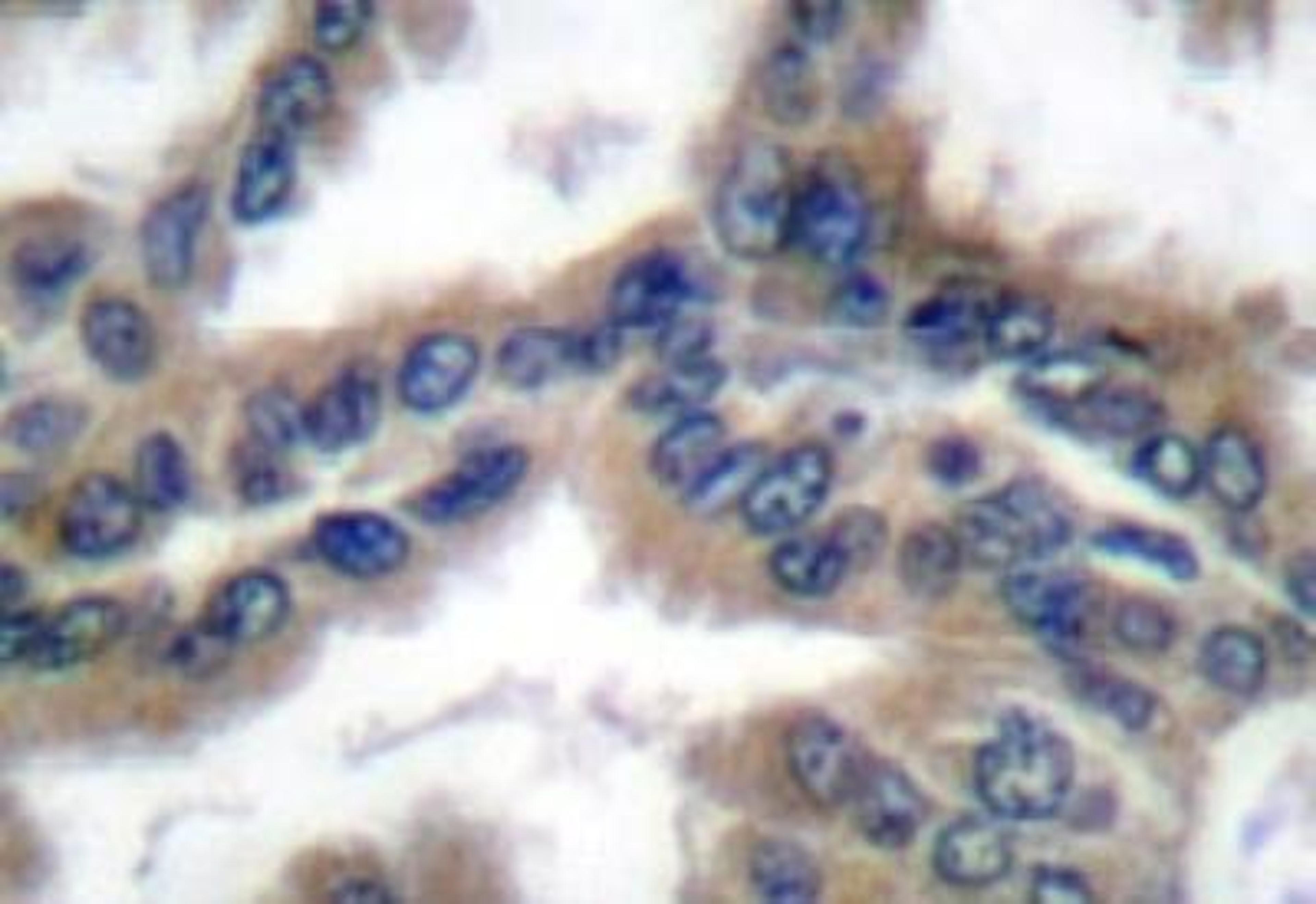 Immunohistochemistry: Hsp40/DNAJB1 Antibody [NB100-91818] -  - Immunohistochemistry  (IHC)  analyzes of  HSP40/HDJ-1 (P303) antibody in paraffin-embedded  lung carcinoma tissue