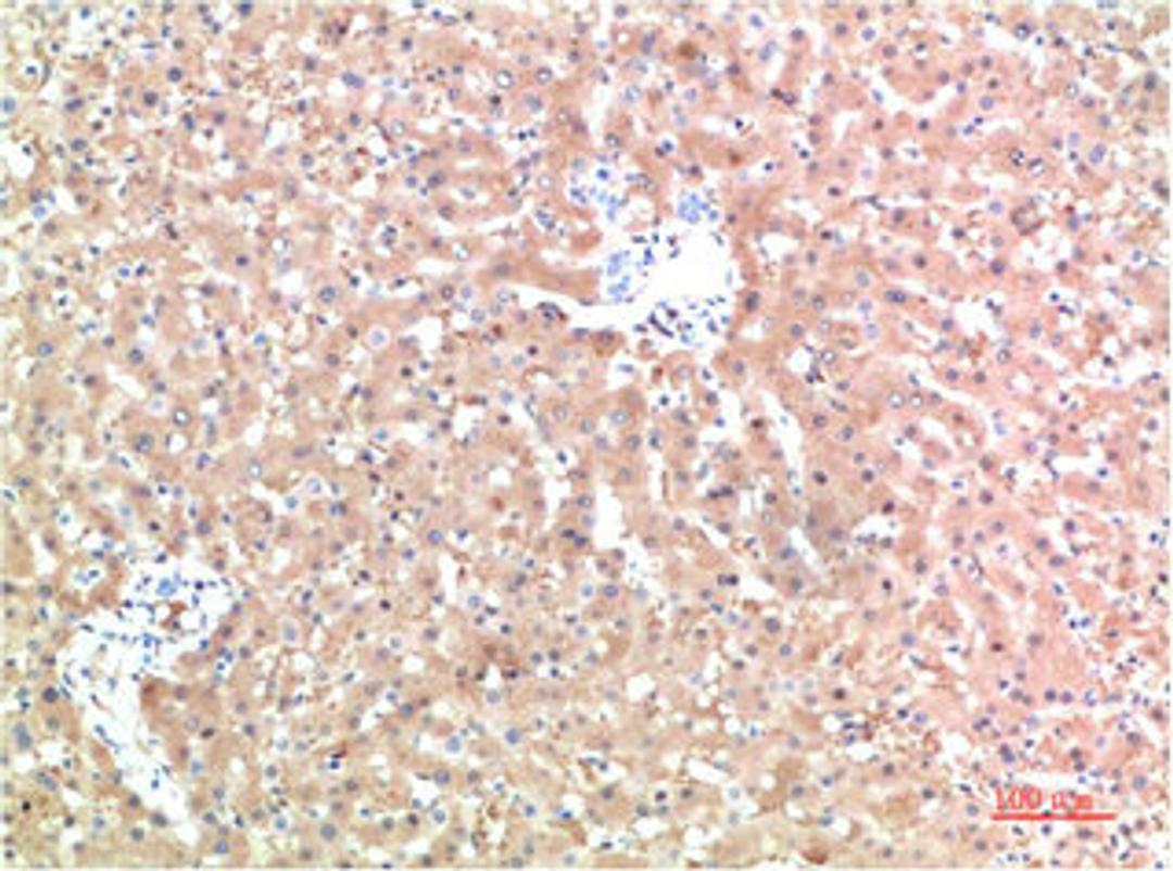 Immunohistochemical analysis of paraffin-embedded Human Liver Carcinoma Tissue using TTR Mouse mAb diluted at 1:200.