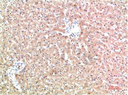 Immunohistochemical analysis of paraffin-embedded Human Liver Carcinoma Tissue using TTR Mouse mAb diluted at 1:200.