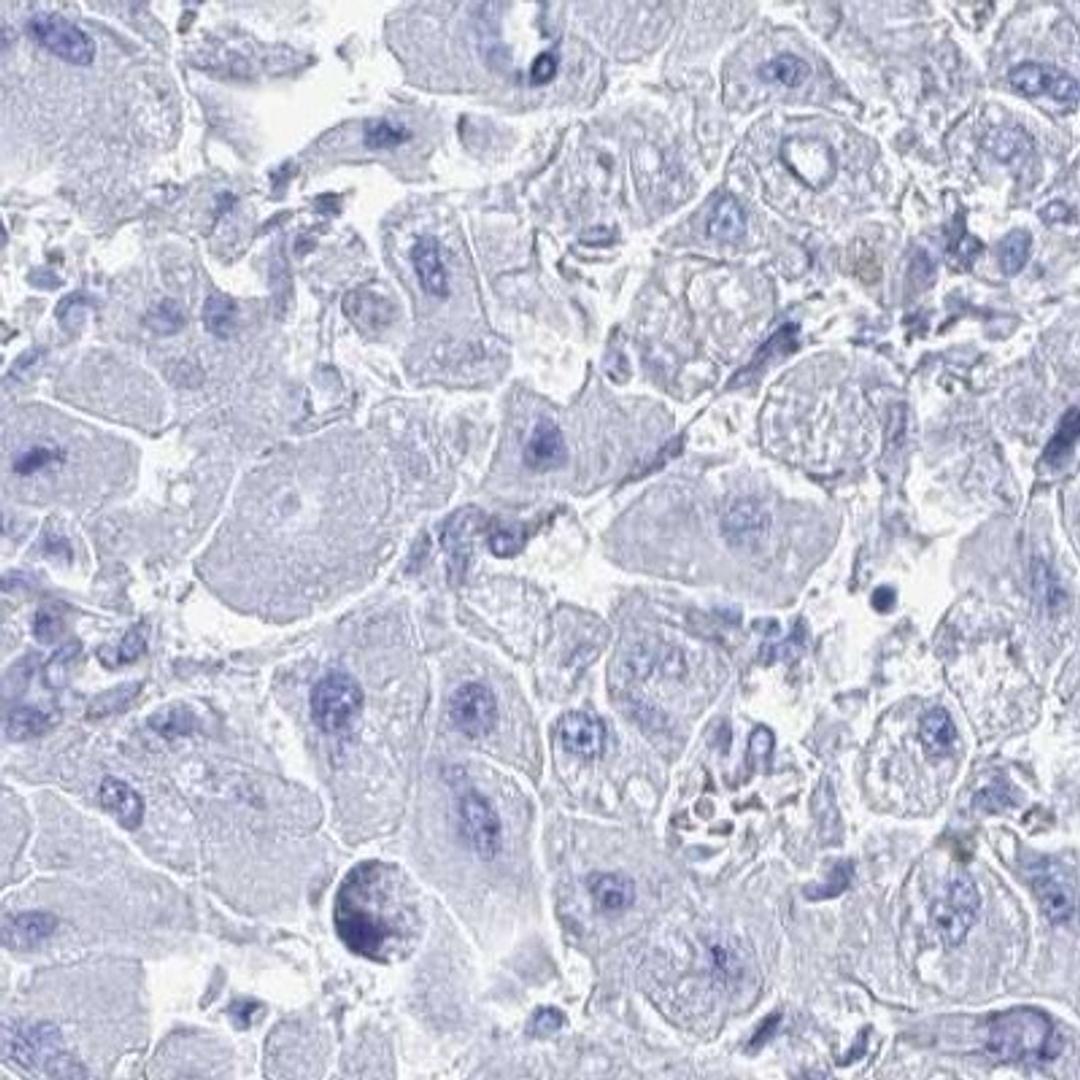 Immunohistochemistry: PLEKHG7 Antibody [NBP2-32558] - liver cancer