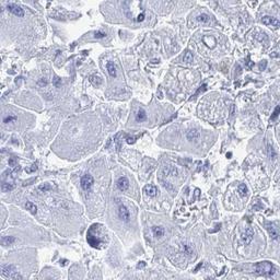 Immunohistochemistry: PLEKHG7 Antibody [NBP2-32558] - liver cancer