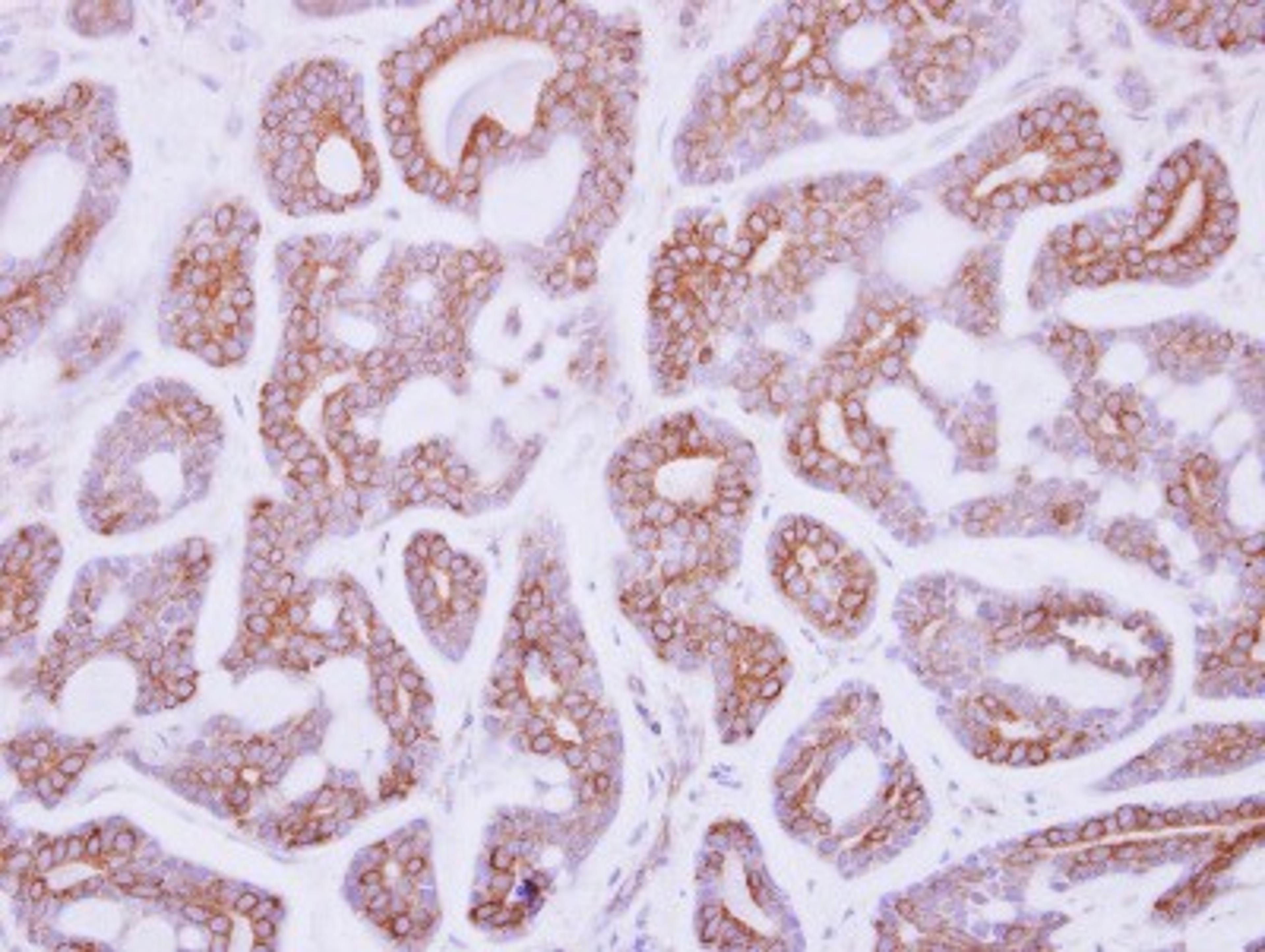 Immunohistochemistry-Paraffin: DDR2 Antibody [NBP2-14926] - Paraffin-embedded Breast carcinoma, using antibody at 1:250 dilution.