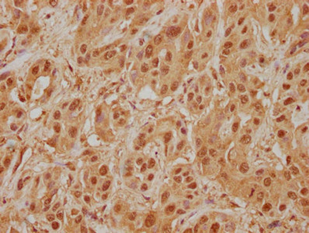 IHC image of CSB-PA013091NA01HU diluted at 1:400 and staining in paraffin-embedded human liver cancer performed on a Leica BondTM system. After dewaxing and hydration, antigen retrieval was mediated by high pressure in a citrate buffer (pH 6.0). Section was blocked with 10% normal goat serum 30min at RT. Then primary antibody (1% BSA) was incubated at 4°C overnight. The primary is detected by a biotinylated secondary antibody and visualized using an HRP conjugated SP system.